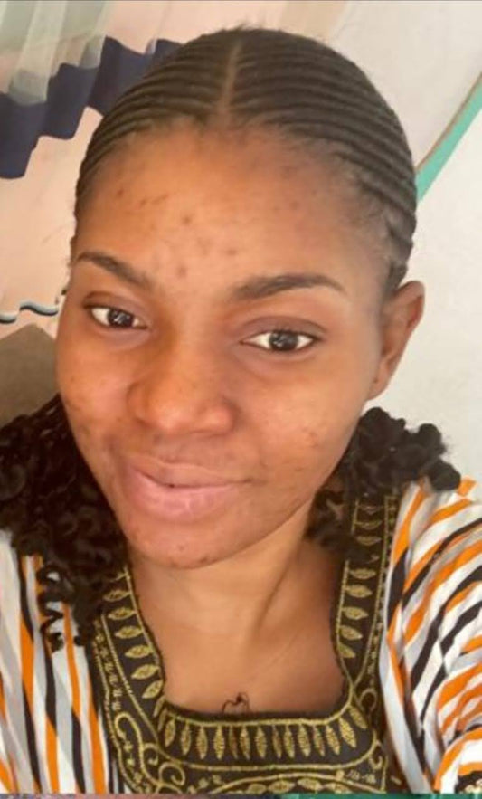 Dark spots fading over time on melanin-rich skin