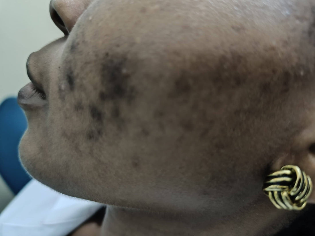 Fading acne dark marks on melanin-rich skin