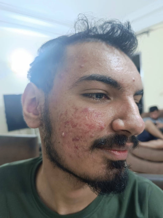 Fading body discoloration on melanin-rich skin