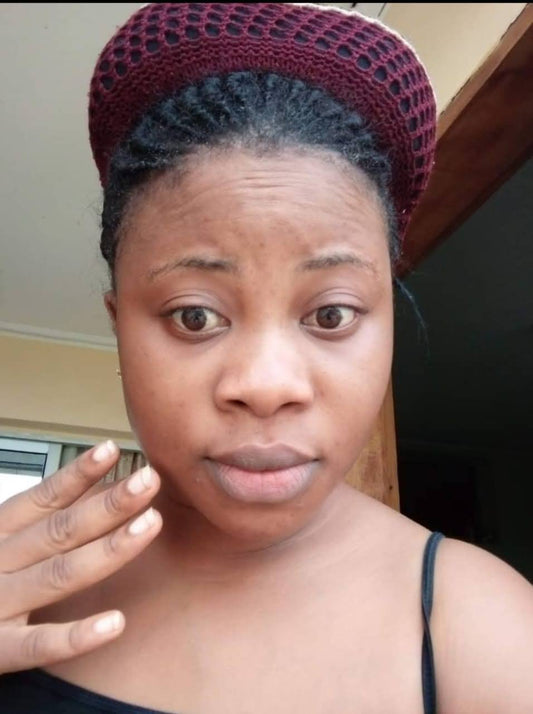 Treating hyperpigmentation on dark skin
